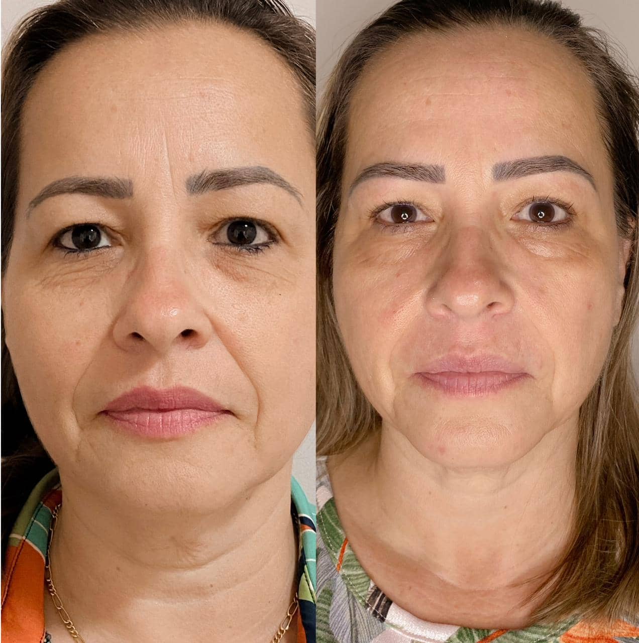 Harmonização Facial